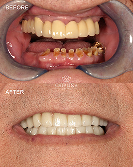 Before After Teeth image