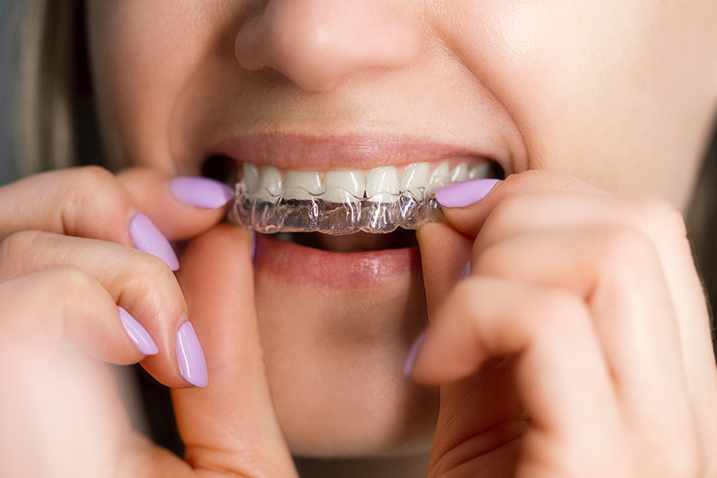 invisalign